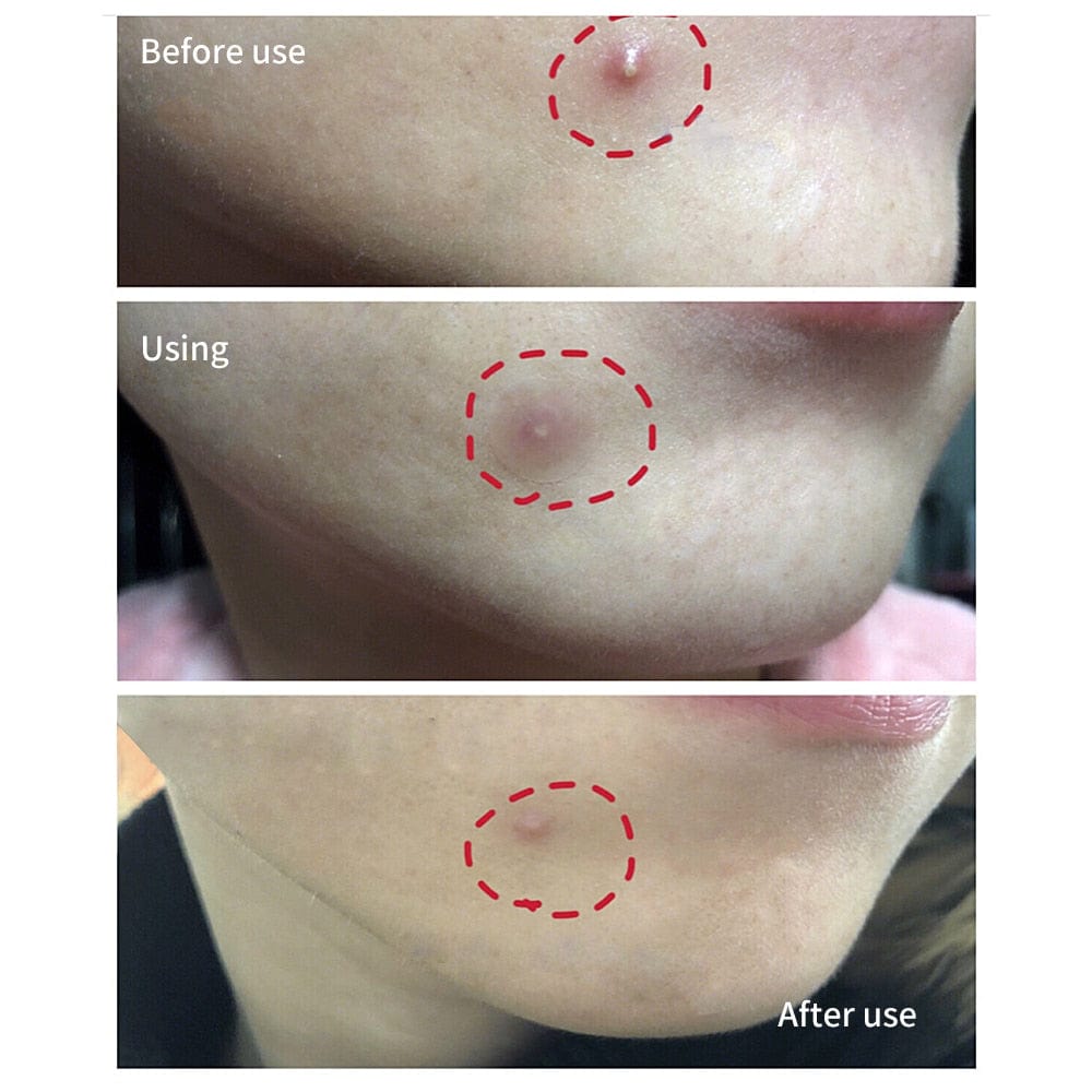 Pimple Patch Acne Spot Treatment